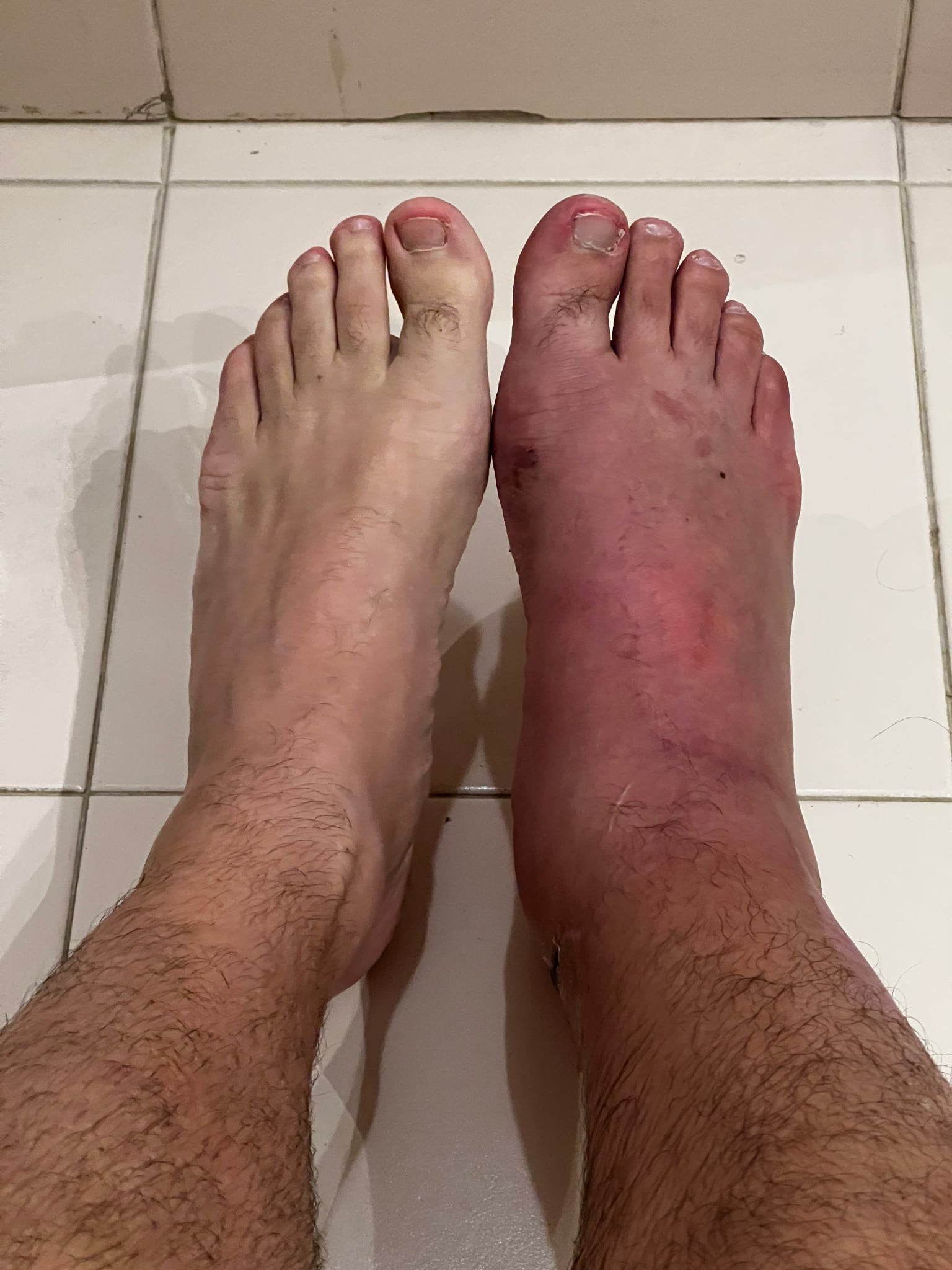 Pié hinchado luego de que me sacaran el yeso